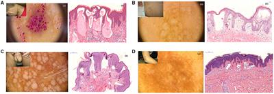 Diagnostic Values of Dermatoscopy and CD31 Expression in Cutaneous Lymphangioma Circumscriptum